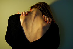 anorexia anorexia