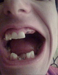 Teeth Decay And Losses caused by Bulimia