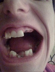 Teeth Decay And Losses caused by Bulimia